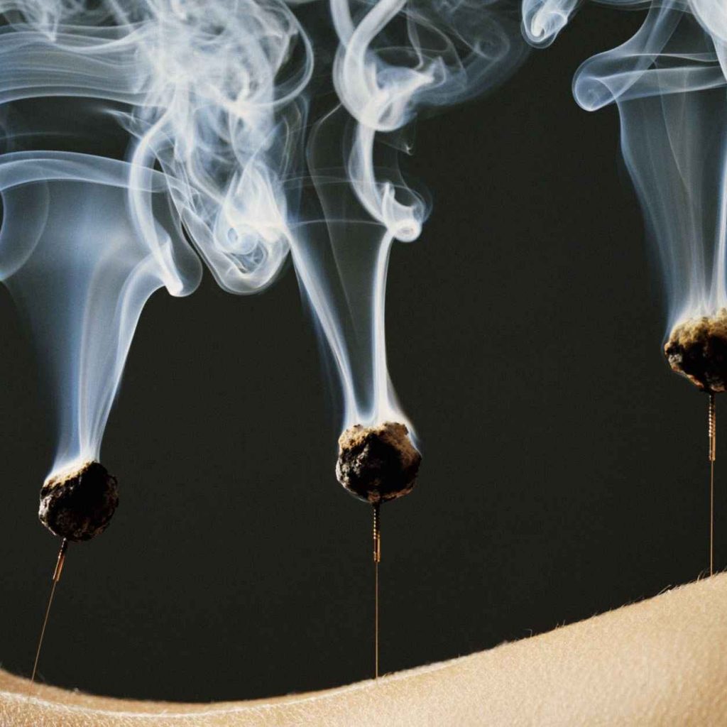  Прижигание (moxibustion)