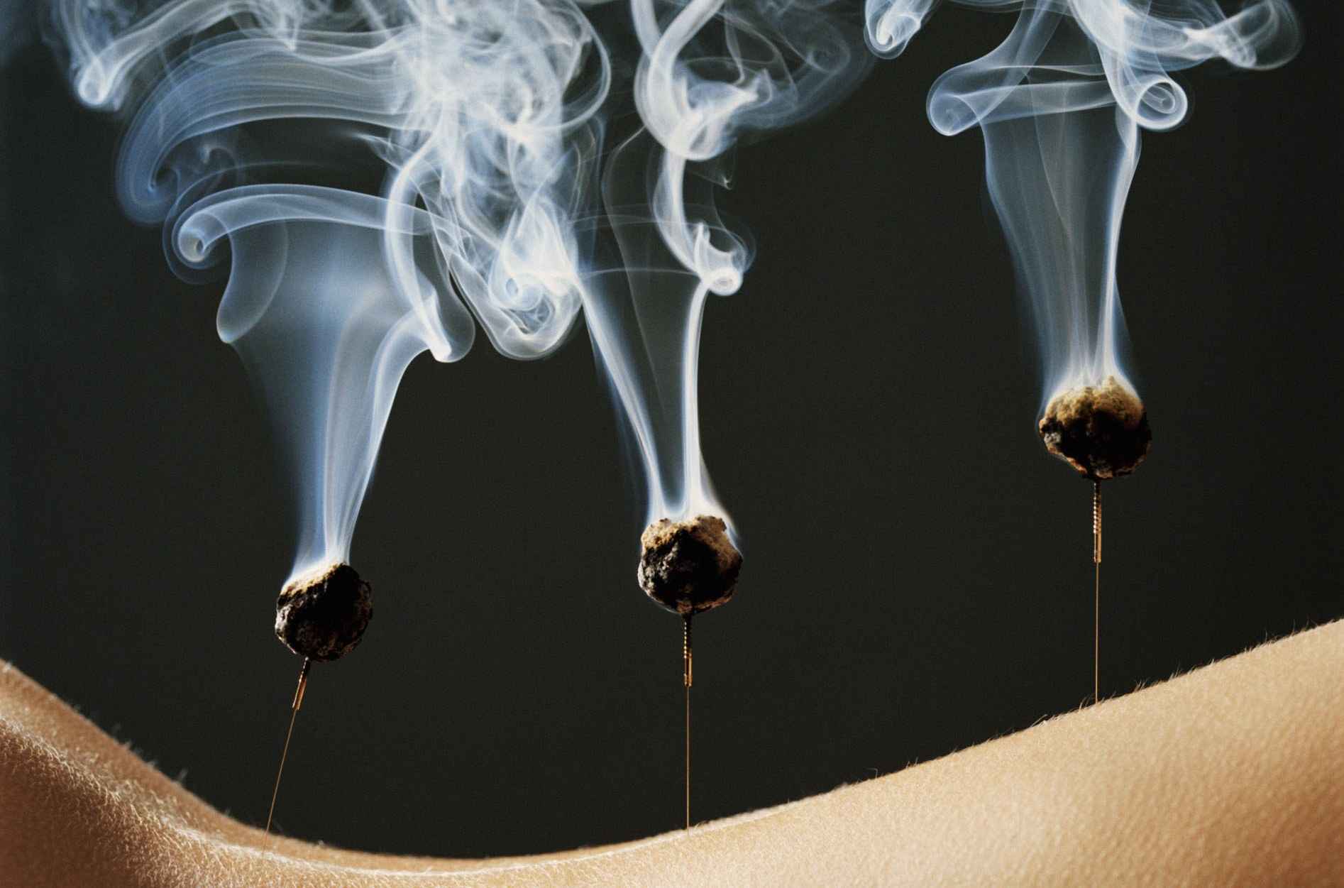 Woman's back with burning moxa on acupuncture needles, close-up